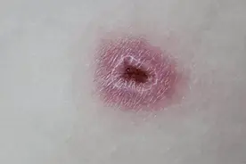 22岁女生小腿上多出一块“大理石纹”！竟是过于“贪暖”造成......图片