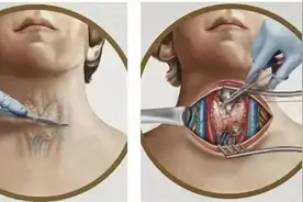 得了甲状腺癌，从腋窝褶皱开刀切除甲状腺，让天鹅颈美丽依旧图片