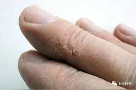 冬天手太干，怎么办？除了擦护手霜，记得还加点它图片