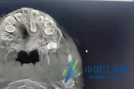 罕见！7岁患儿上鄂竟长出“萝卜”样牙齿 这件事家长莫忽视图片