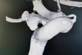 不得了，杭州一女子脑里的“临时炸弹”炸了！这种病致死致残率极高，女性发病率高于男性……图片