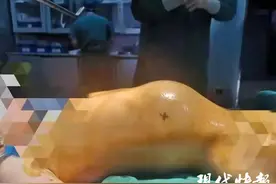 5岁女孩腹部“鼓包”，肚子里取出脑袋大肿瘤图片