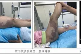 首例！欺负儿童的“恶魔”KT综合征，开展联合手术图片