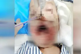 49秒丨家有烧碱赶紧藏好 一岁娃误吃一口进了ICU视频封面