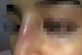 南宁一女子做隆鼻手术后反复肿胀、发炎！整形机构拿出一份“神秘”的体检报告……图片