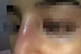 南宁一女子做隆鼻手术后反复肿胀、发炎！整形机构拿出一份“神秘”的体检报告……图片