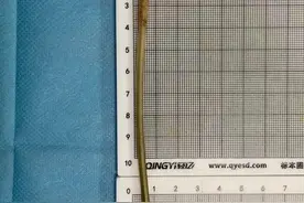 咋进去的？女子腹痛体内发现15厘米长钉，自述曾喝朋友递的水图片