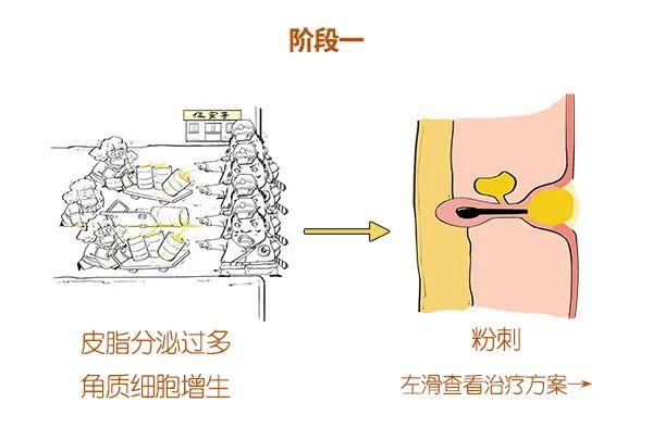漫画科普：求求你，别“痘”我！