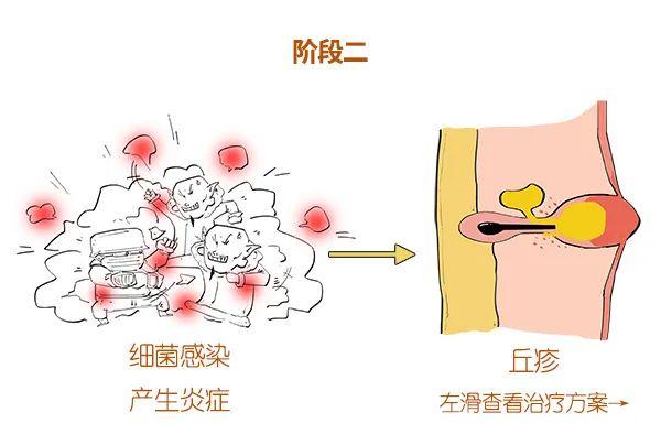 漫画科普：求求你，别“痘”我！