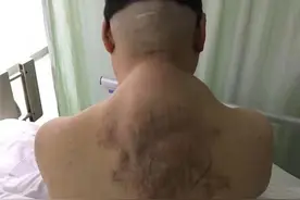 男子脖子后面挂了个“篮球”医生用了近13小时才把它取下来图片
