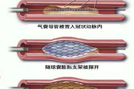 心内科梁春教授：3种冠状动脉支架有哪些你还不了解？图片