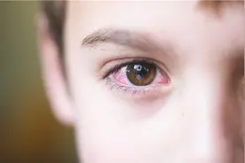 眼球充血是怎么回事？视频封面