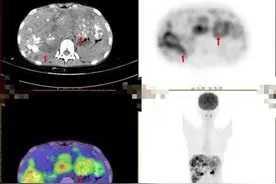 15岁少女和乔布斯患同款肿瘤 广州医生为其赢来生机图片