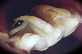 女子误吞异物卡喉 医生一查：整只螃蟹卡在食道视频封面