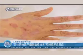 红斑狼疮治疗新突破！“异体间充质干细胞治疗技术”可降不良反应视频封面