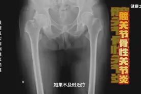 你的髋关节还好吗？3个小测试速来检查图片