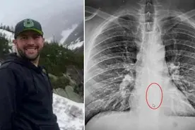 英国男子喝水难以下咽 拍片才知AirPod卡在食道图片