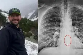 英国男子喝水难以下咽 拍片才知AirPod卡在食道图片