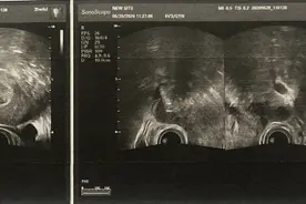 25岁女子3年人流5次，自认为无痛人流最省事，医生都震惊了图片