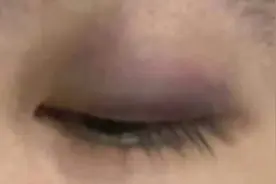 中国留学生在澳大利亚无端遇袭 眼眶被打肿角膜受伤图片