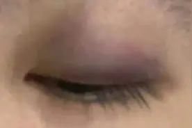 中国留学生在澳大利亚无端遇袭 眼眶被打肿角膜受伤图片