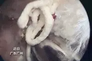 小伙痛风膝盖竟挤出牙膏状结晶，尿酸高达800多！网友直呼：我的天哪图片
