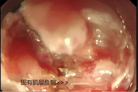 误吞鱼刺用“土方法”，导致鱼刺扎入食管数日 苏大附二院专家巧用胃镜取出图片