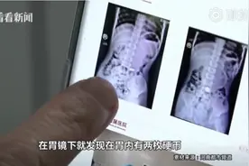 男孩吃饺子吞下2枚硬币，1年后才取出视频封面