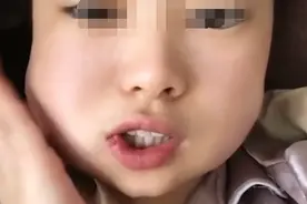 山东一女子把3颗智齿一次性拔完：手术中途吓哭，脸肿得像土拨鼠图片