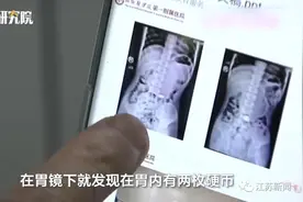 11岁男孩春节吃饺子吞下2枚硬币，1年后才取出！网友沸腾了图片