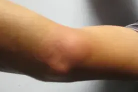 小儿桡骨头半脱位在家如何复位呢？外科医生来教您视频封面