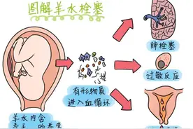 徐医附院麻醉科 | 一例羊水栓塞术前、术中的麻醉方案图片