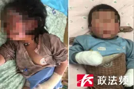 揪心！湖南浏阳小姐弟双双被烧伤，家中这个隐患一定要重视图片