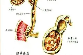 看完这篇，你就明白胆结石是怎么回事了图片