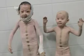 他们快乐得令人心疼！山东妈妈视频记录烧伤兄妹康复历程，病房里唱歌跳舞玩游戏图片