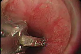 “吞金兽”赌气吞硬币，卡在了食道图片