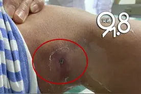 杭州女子突然全身冒红斑，没想到是因为这个“不速之客”图片