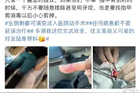 疼！香港演员邓萃雯拔倒刺做手术上热搜，曾有4岁女孩拔倒刺失去一根手指图片