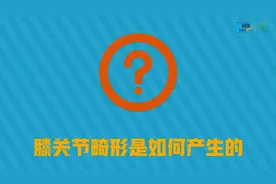 「健康解码」膝关节畸形要警惕 不仅是难看图片