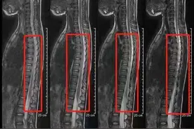 广州一9岁女孩舞蹈班练倒立时摔倒 竟致脊髓损伤、截瘫图片
