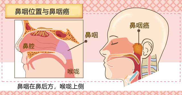 非角化癌会扩散吗
