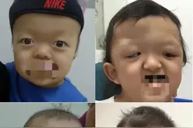 外星娃娃的大眼睛——浅谈颅缝早闭儿童的眼部疾病图片