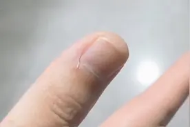 不能拔不能啃！倒刺要这样处理：一泡二剪三擦视频封面