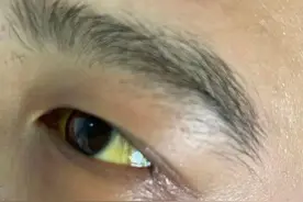 连续聚餐后，27岁小伙嗜睡多日，全身发黄！检查发现这器官功能衰竭图片