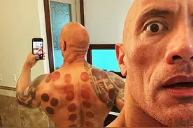 巨石强森晒拔火罐自拍分享心得 网友点评：湿气重图片