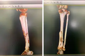 同一个位置两次骨折，他跨省奔波，终于在这看到“重生”的曙光图片