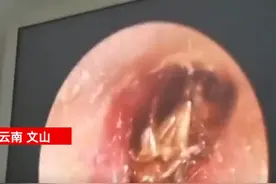 女童一觉醒来耳朵疼得大哭，医生检查发现竟有只蟑螂死在耳内图片