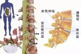 腰椎间盘突出如何自查？图片