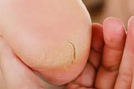 冬季脚裂多半与这2个因素有关，经常泡脚能养护脚部健康图片