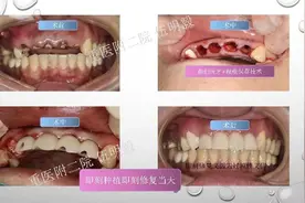 聚焦•宽仁前沿｜第30期，门牙缺失怎么办？精准保存1mm根壁即刻种植当天用图片
